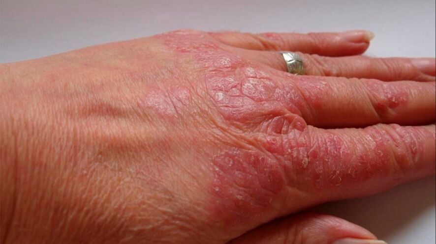 simptome de psoriazis pe mâini
