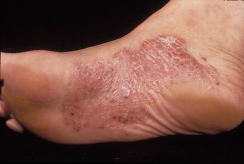 simptome de psoriazis pe picior