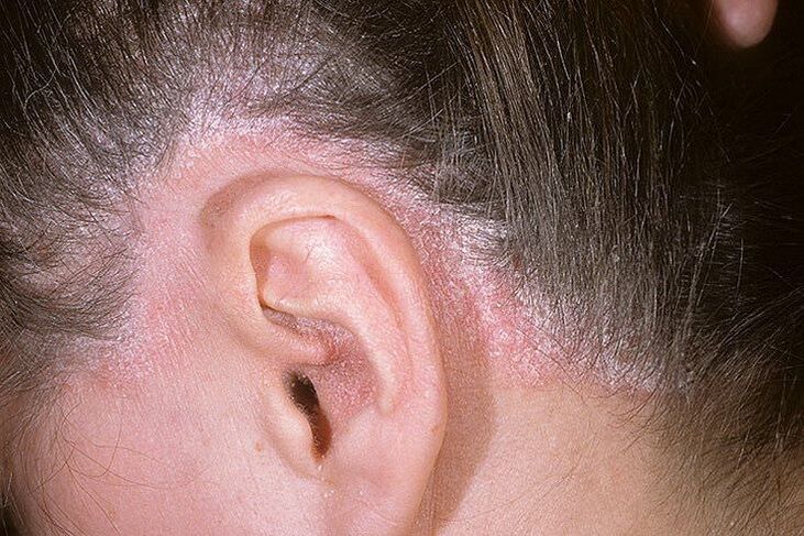 Erupții de psoriazis pe cap în spatele urechilor