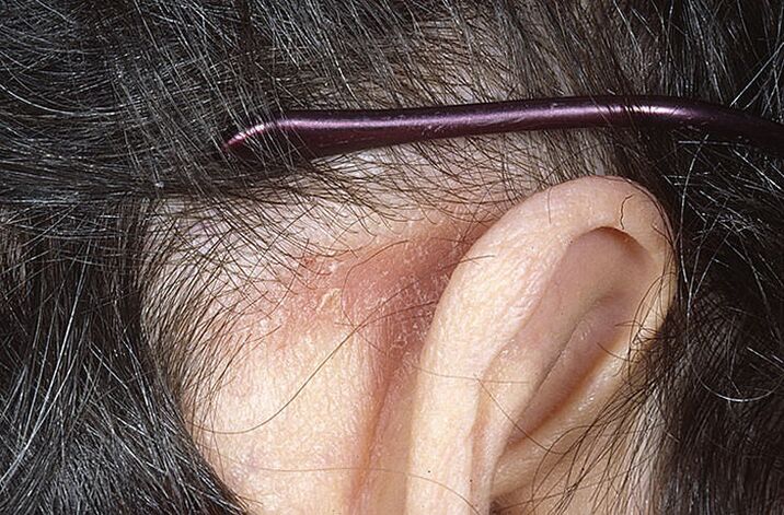 Placa psoriazica in spatele urechii