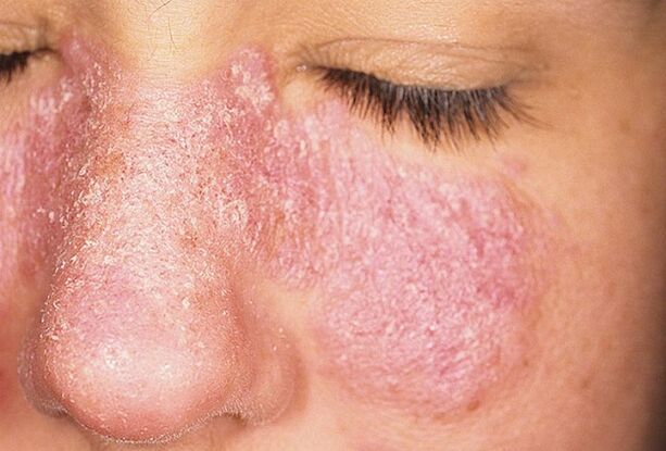 Etapa progresivă a psoriazisului pe pielea feței
