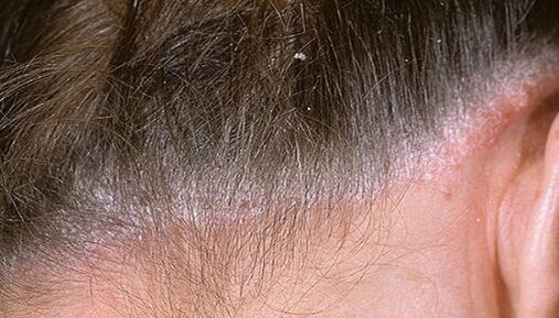 Psoriazis pe cap