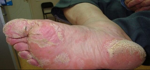 Psoriazis pe picioare