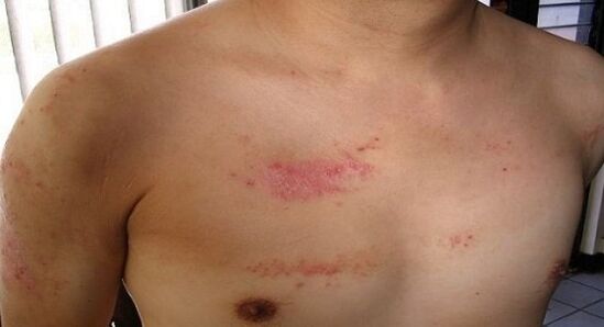 Psoriazis în zona pieptului