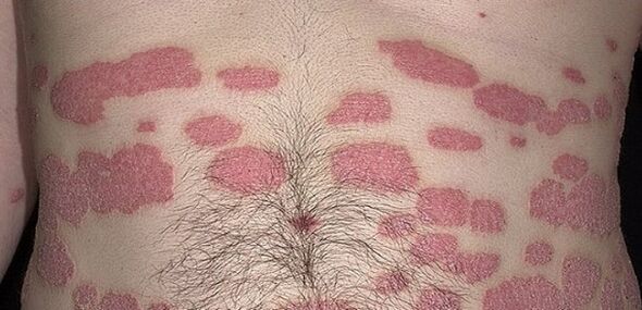 Psoriazis