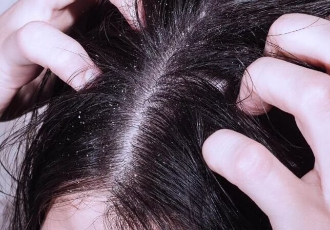 Psoriazis pe cap