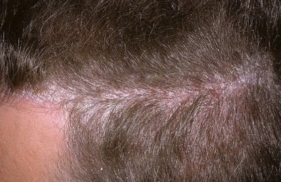 Psoriazis pe cap