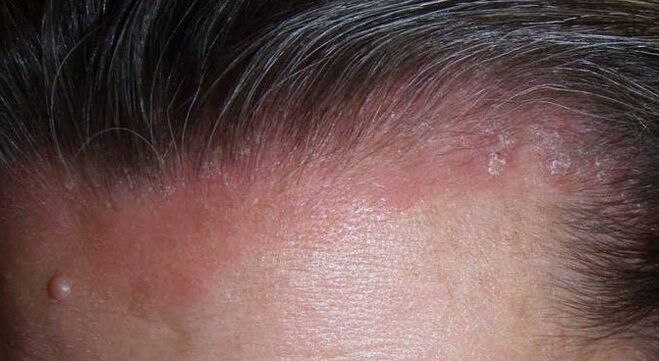 Ce este psoriazisul