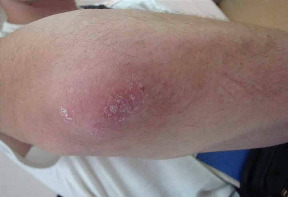 Cum arată psoriazisul