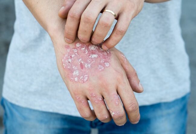 Psoriazis mesnichered