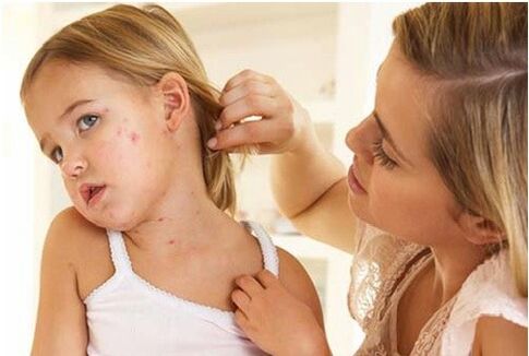 Psoriazis la copii