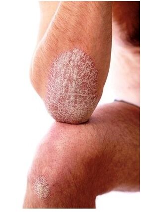 Psoriazis pe cot