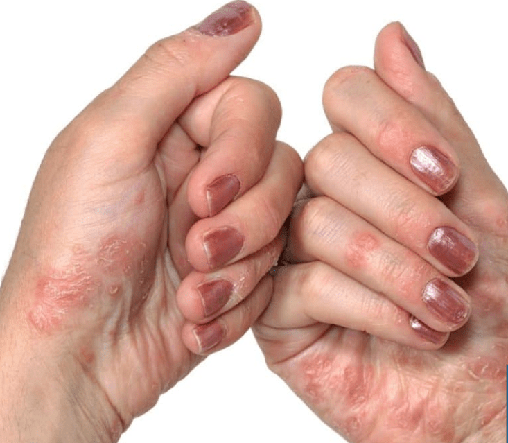 Psoriazis în mâini