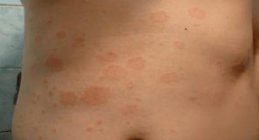 Psoriazis nefericit