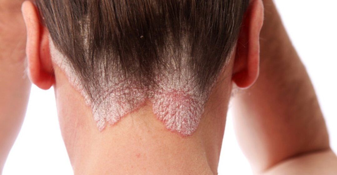 Psoriazis pe capul fetelor