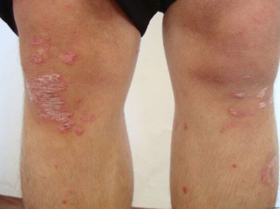 Cauzele psoriazisului
