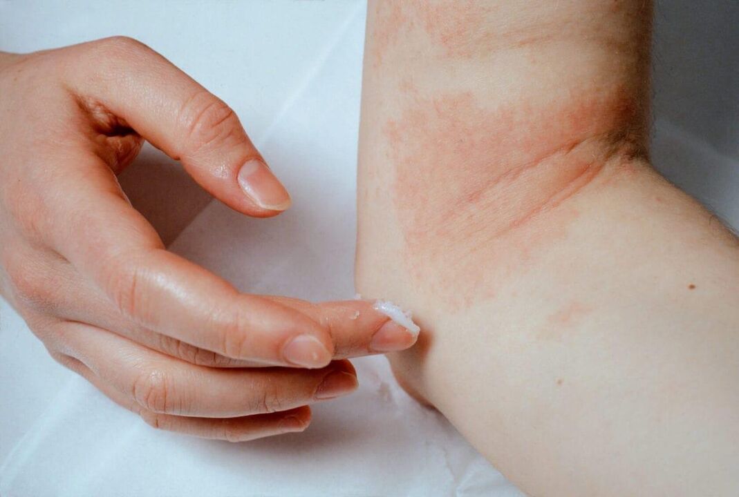 Tratamentul psoriazisului