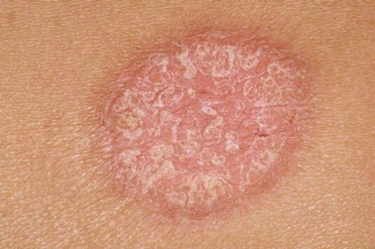 psoriazis