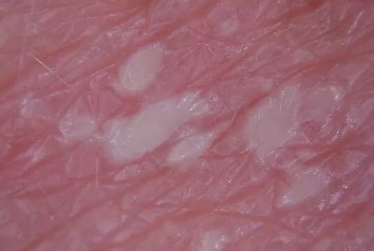 Psoriazis Pustulenia