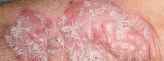 Psoriazis mesnichered