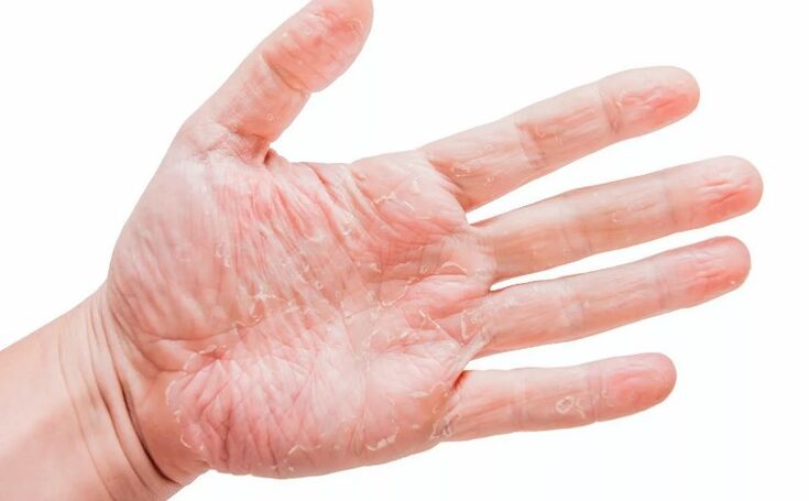 Psoriazis
