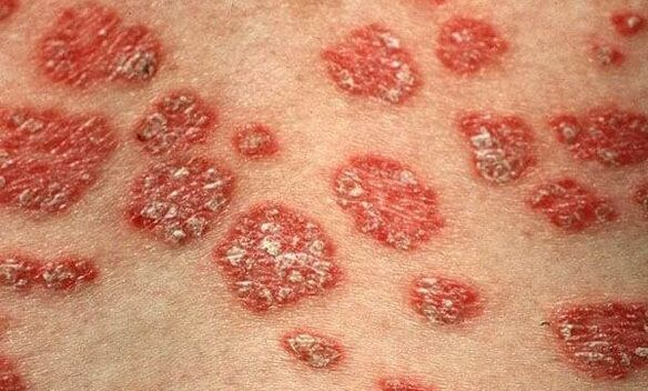Forme de psoriazis