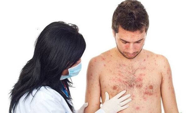 Fotografie psoriazis
