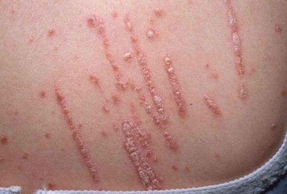 Psoriazis pe corp