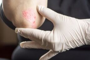 Psoriazis pe cot