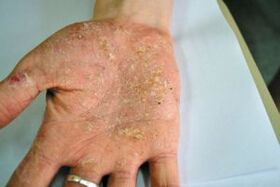 Psoriazis în palma mâinii tale