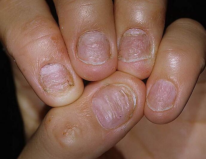 Psoriazisul unghiilor