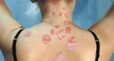 Psoriazis