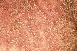 Psoriazisul pustular