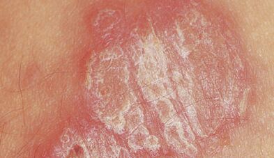 psoriazis