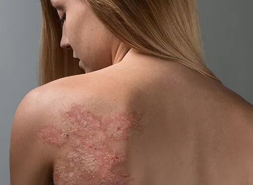 Psoriazisul pe spatele unei fete