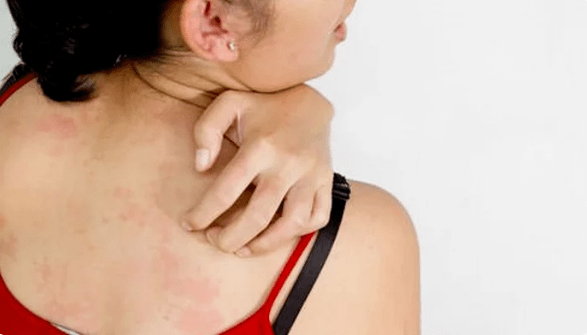 psoriazis