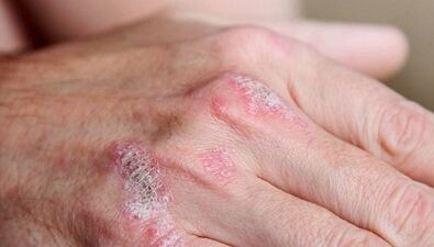 simptome ale stadiului inițial al psoriazisului