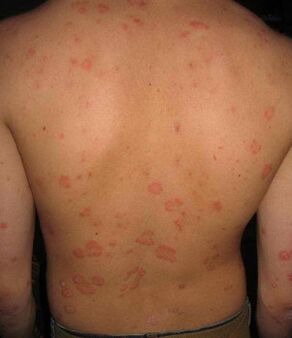 psoriazis pe spate