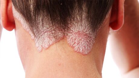 Plăci psoriazice pe scalp