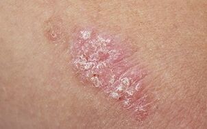 cauzele psoriazisului