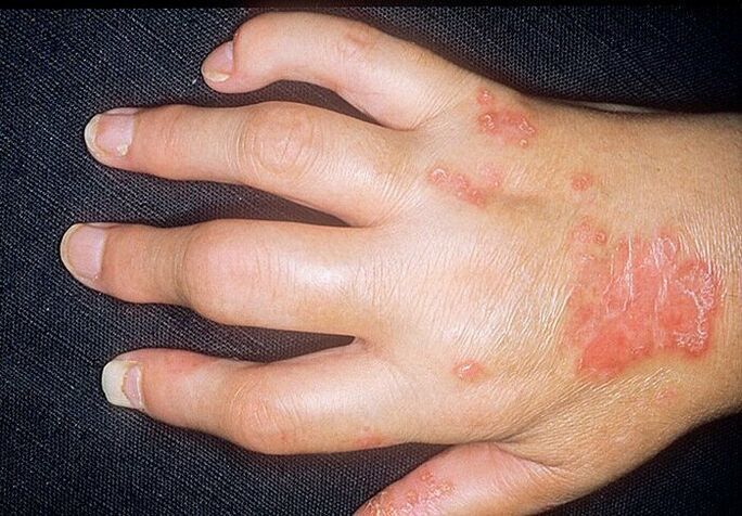 artrita psoriazică pe mâini