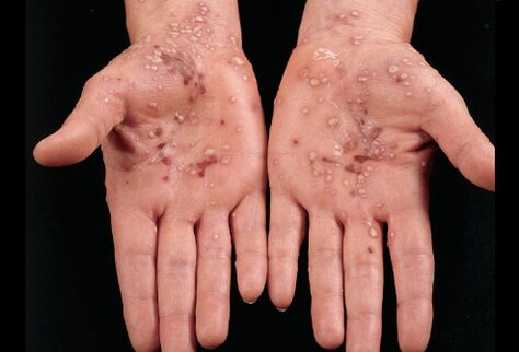 cum arată psoriazisul pe palmele mâinilor