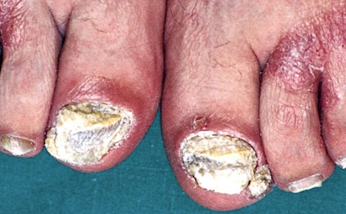 Hiperkeratoză subunguală severă și plăci psoriazice pe degetele de la picioare
