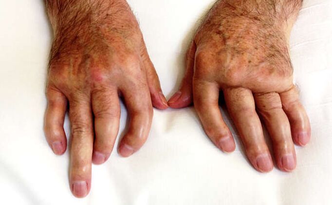 Mutarea artritei în psoriazis