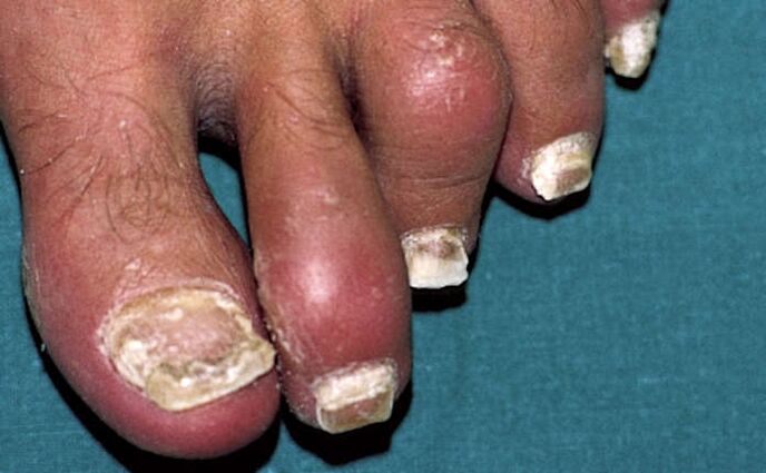 Psoriazis cu afectarea unghiilor și inflamația articulațiilor (artrita) degetelor de la picioare