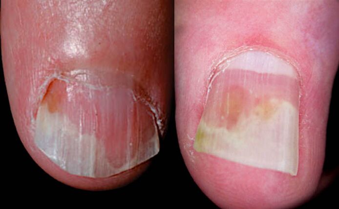 Simptom al unei pete de ulei - zone de culoare somon lângă zona de onicoliză