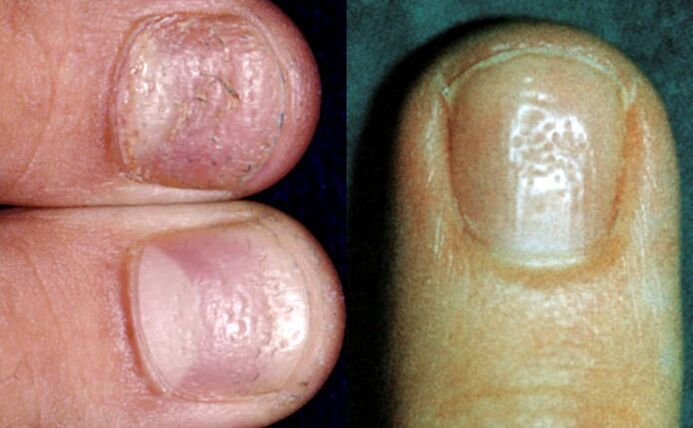 Simptom degetar - depresiuni multiple pe suprafața plăcii unghiei