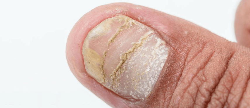 formă acută de complicații ale psoriazisului pe unghie
